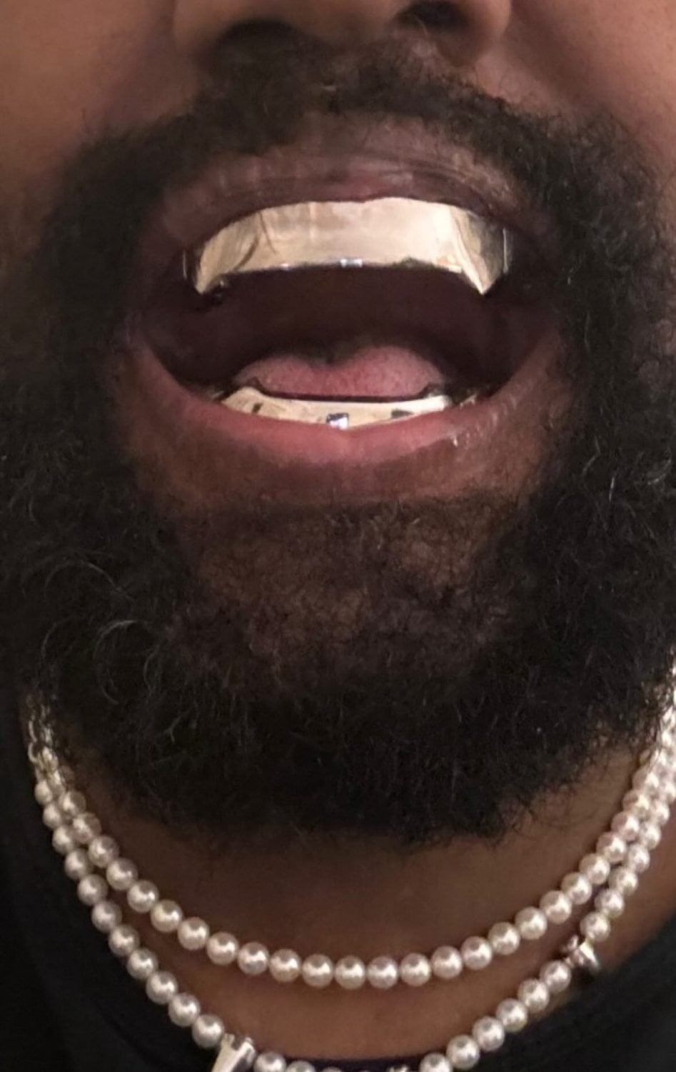 Kanye West Gets Custom Titanium Dentures